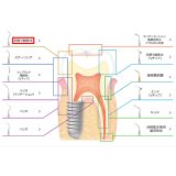 ナカニシ バリオスチップ 初期う蝕除去