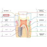 ナカニシ バリオスチップ スケーリング