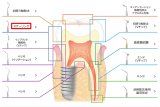 ナカニシ バリオスチップ スケーリング