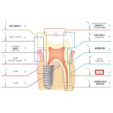 ナカニシ バリオスチップ エンド