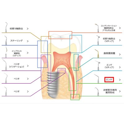 画像1: ナカニシ バリオスチップ エンド