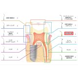 ナカニシ バリオスチップ 歯根膜剥離 G95