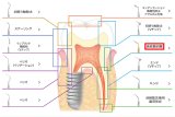 ナカニシ バリオスチップ 歯根膜剥離 G95