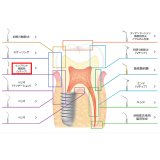 ナカニシ バリオスチップ インプラント・補綴物