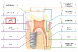 ナカニシ バリオスチップ インプラント・補綴物