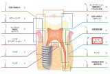 ナカニシ バリオスチップ エンド（Vチップ）