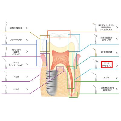 画像1: ナカニシ バリオスチップ エンド（Vチップ）