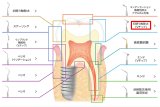 ナカニシ バリオスチップ 初期う蝕除去（Vチップ）