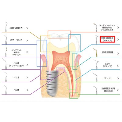 画像1: ナカニシ バリオスチップ 初期う蝕除去（Vチップ）