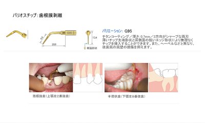 画像1: ナカニシ バリオスチップ 歯根膜剥離 G95